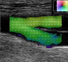 ultra sound flow